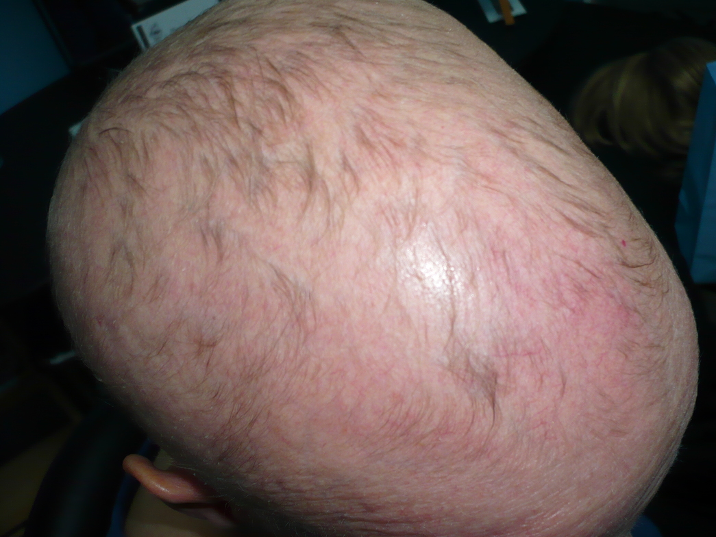 Alopecia 1 Hair Pieces West Coast Wigs